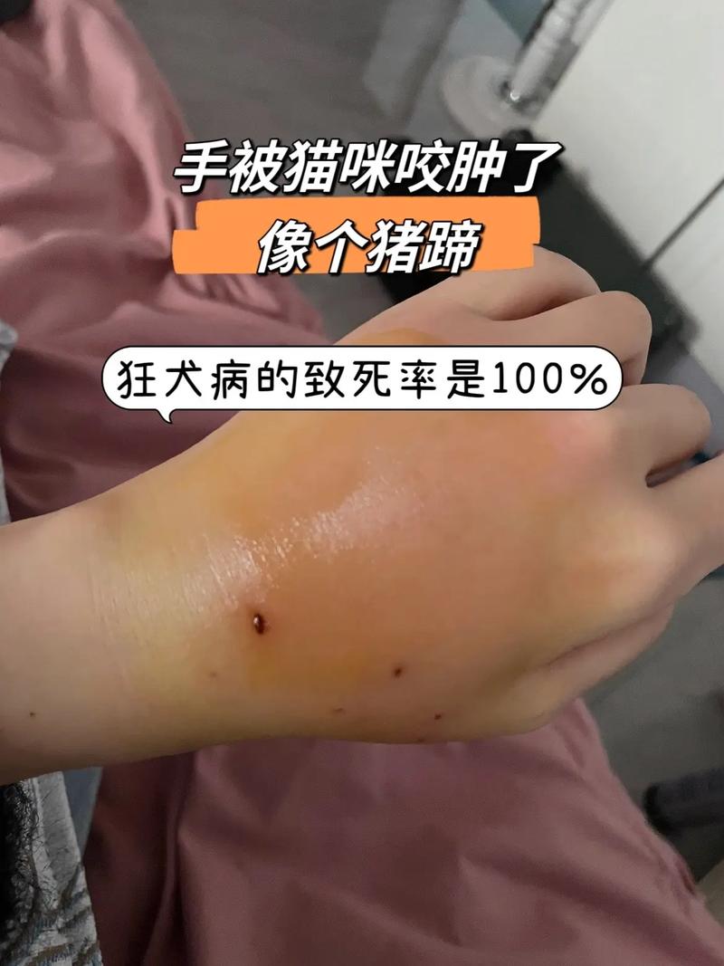 手被狗咬了肿了怎么办，狗咬手红肿？快用肥皂水冲洗消毒，不确定狂犬疫苗快打！