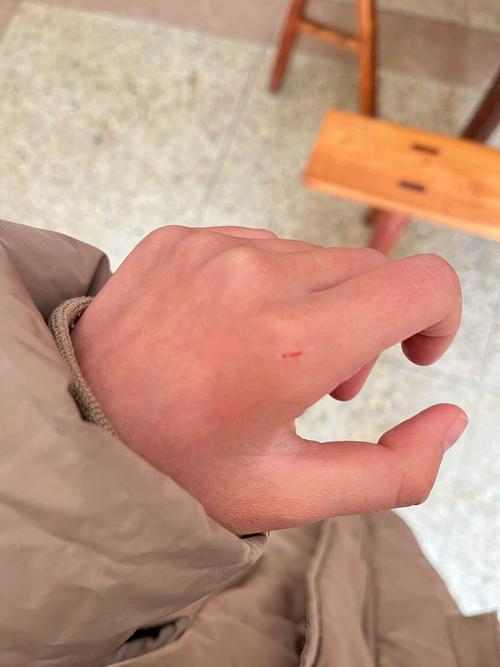 被自己家猫抓了轻微出血有事吗，猫抓破皮出血？别大意，快处理打疫苗！