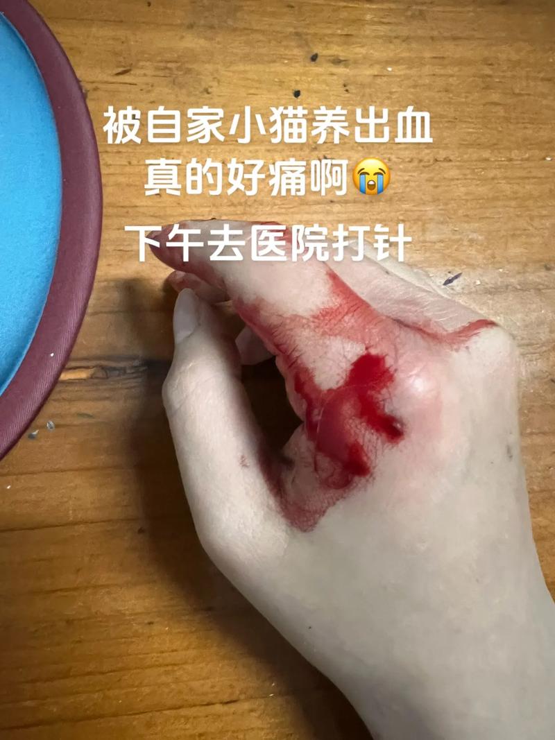 被家养猫咬了出血了会怎么样,猫咬出血要当心,速处理防感染! 被家养猫咬了出血了会怎么样,猫咬出血要当心,速处理防感染!