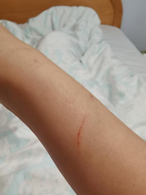 被家猫抓了，猫抓咬伤别大意，及时处理打疫苗